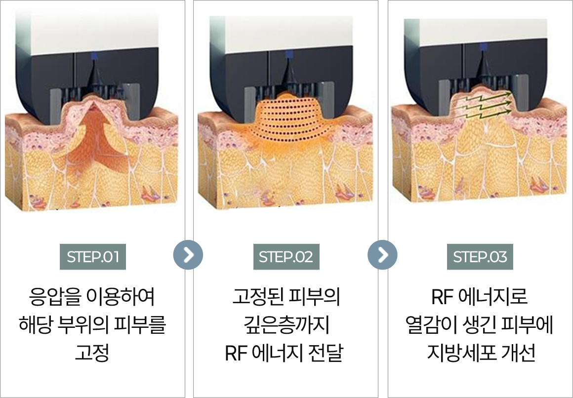 강남 논현 피부과 루아크 바디 인모드 기계 시술 단계