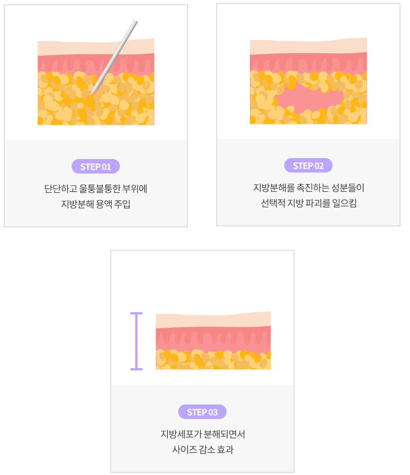 강남 논현 피부과 루아크 슬림핏 시술 원리